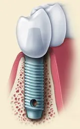 dental implants anchor replacement teeth into the jaw